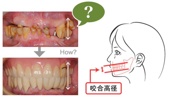 咬合 高 径 と は