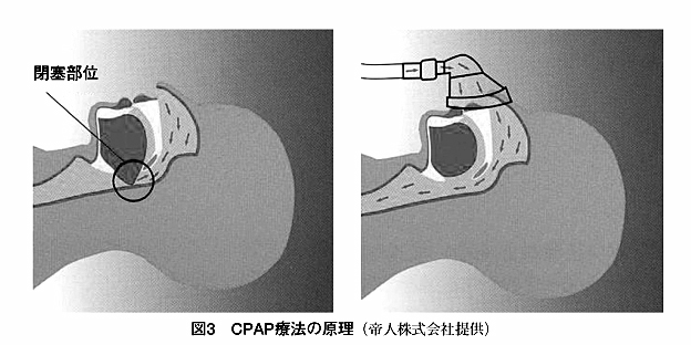 図3：CPAP療法の原理