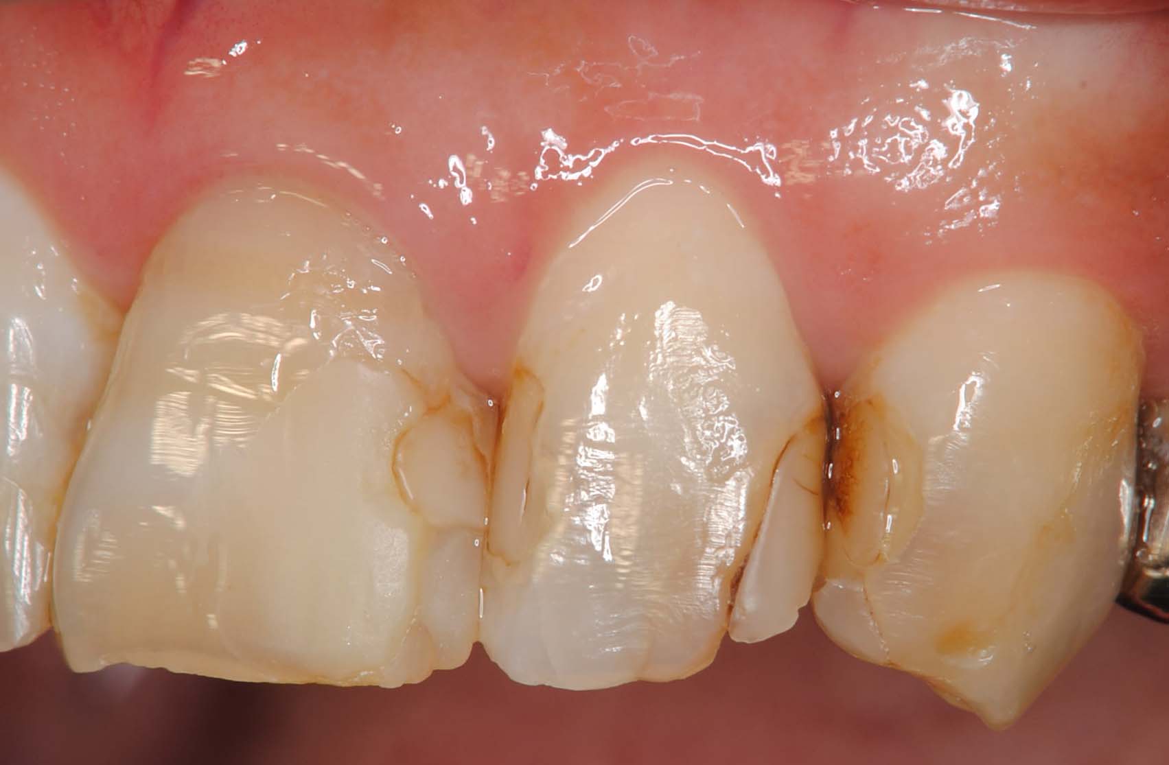 前歯 の 歯茎